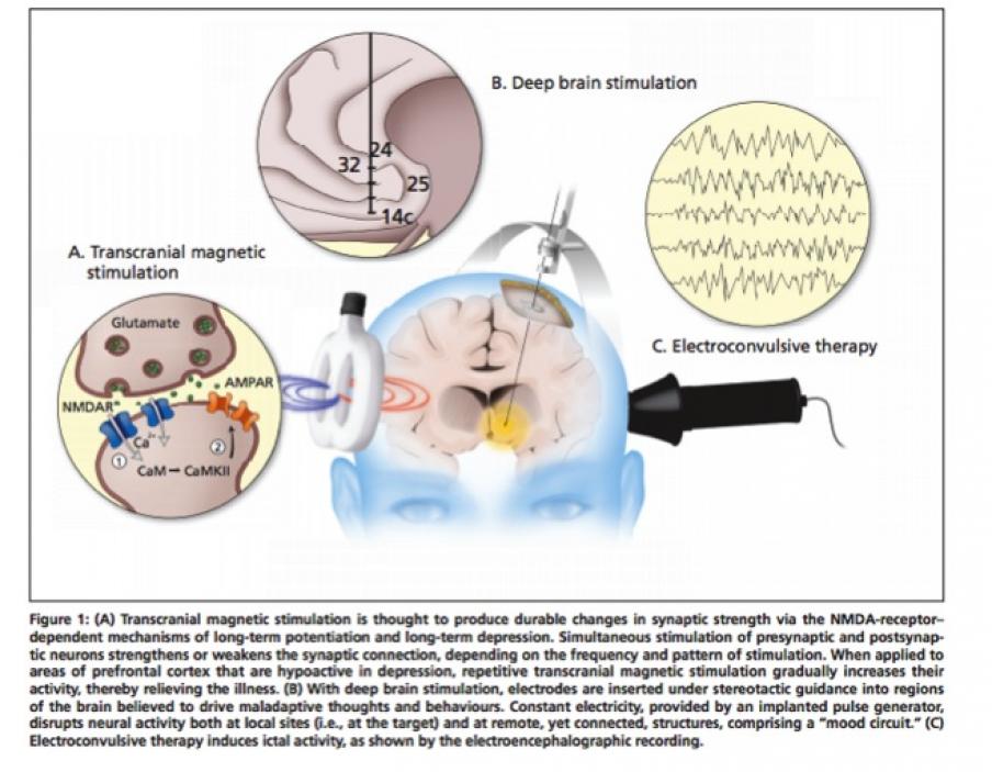 Demystifying Electroconvulsive Therapy (ECT) – “It’s Nothing Like the ...